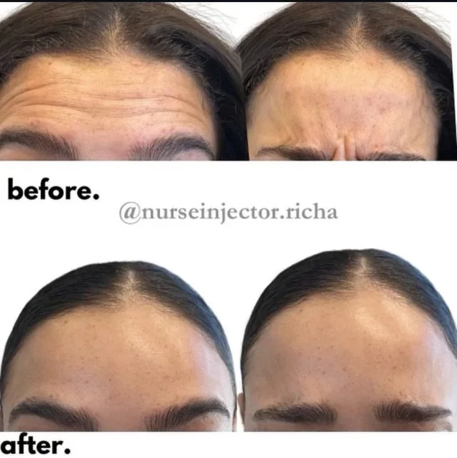 Botox & neuromodulators photograph published by NFMA
